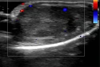 Testicular ischemia associated with IgA vasculitis in a child: a case report and literature review